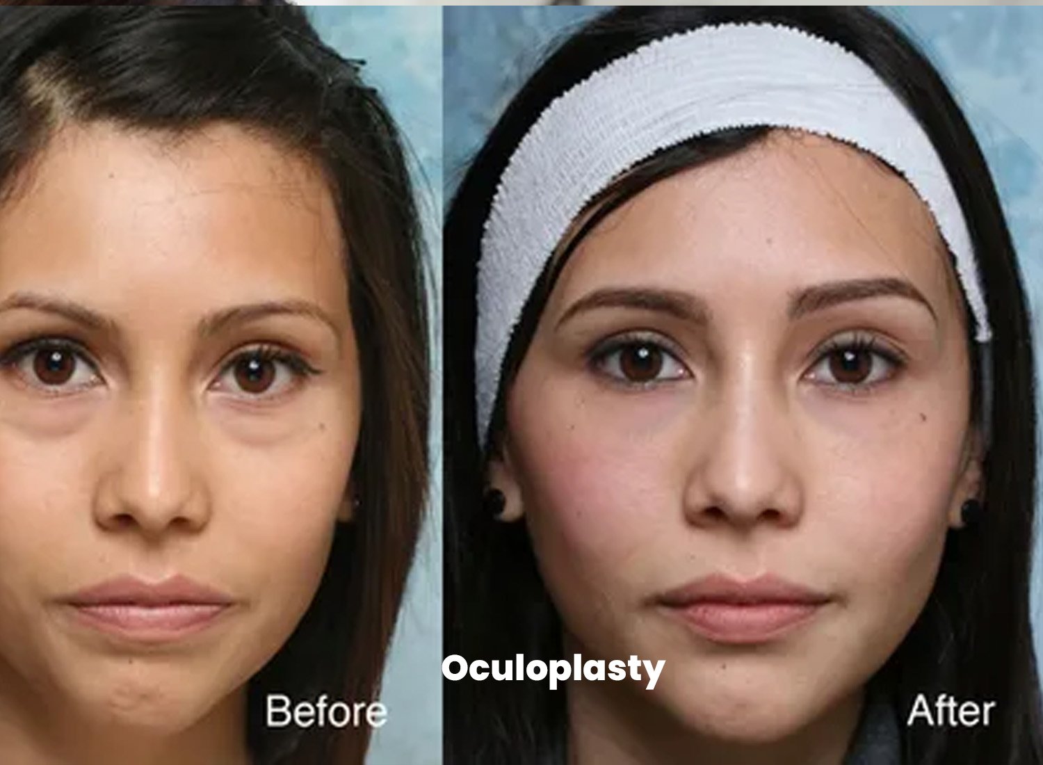 Oculoplasty