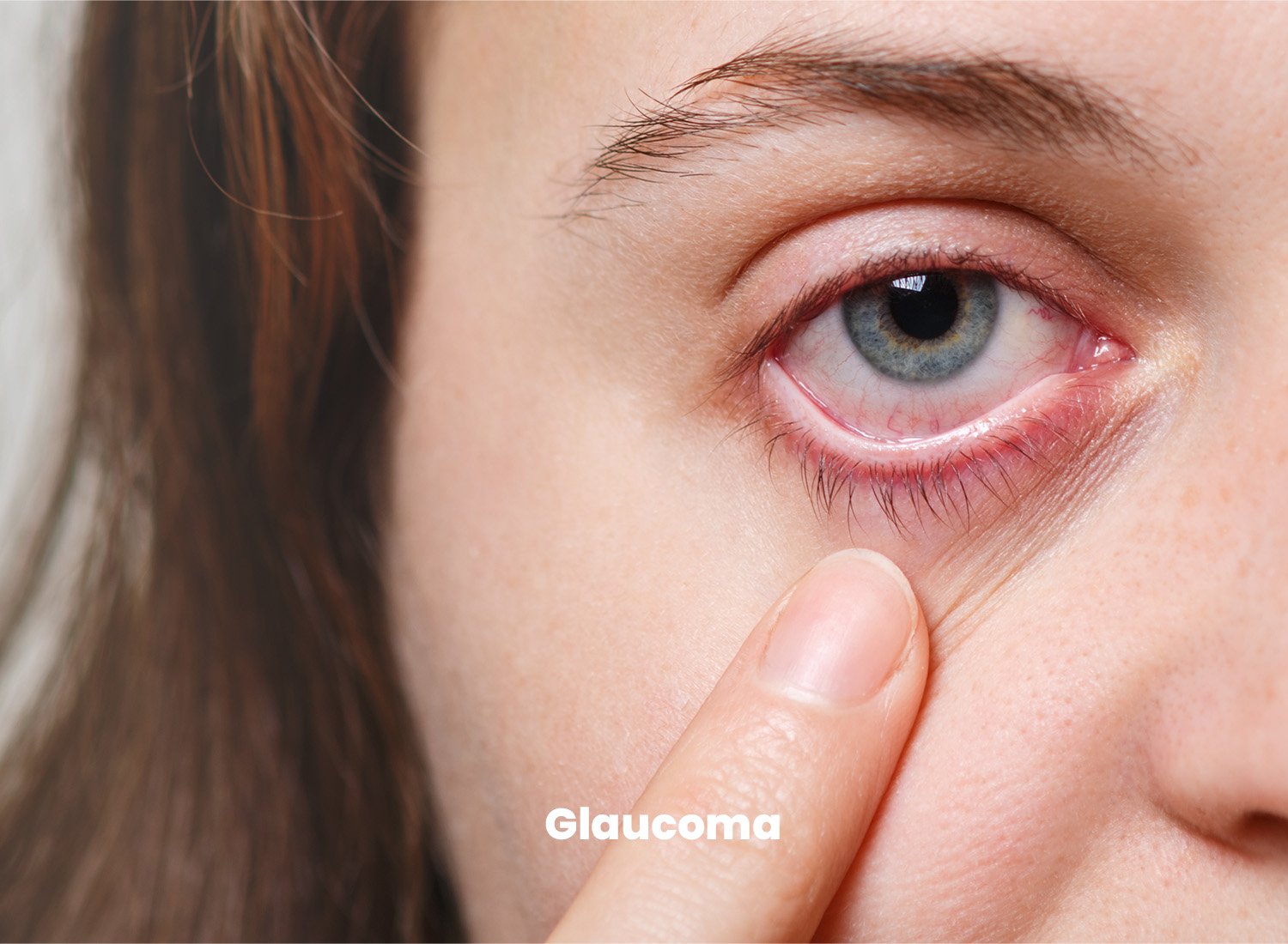 Glaucoma Treatment