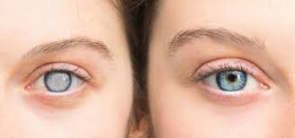 Best cataract surgeon in Madurai