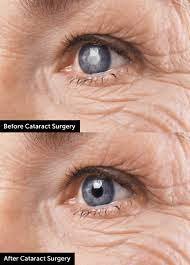 Best Cataract Surgery in Madurai